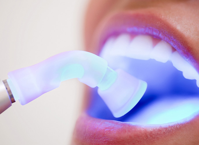 Mouth open with instrument light on filling composite